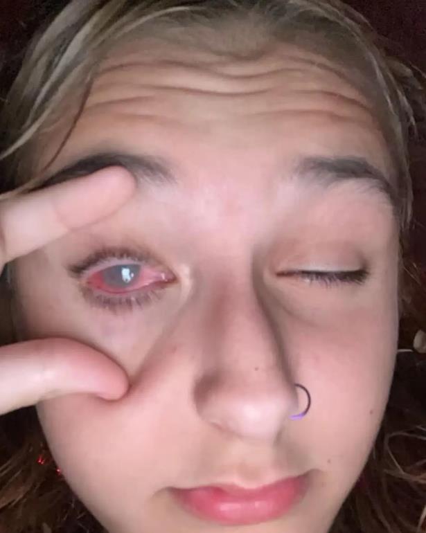 眼角膜疤痕修复最新技术详解，观点阐述与解析